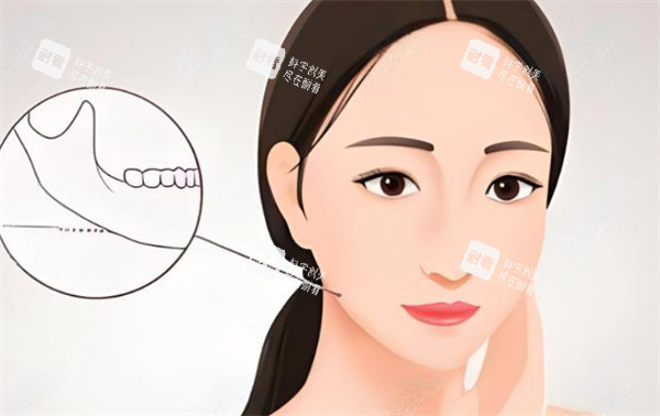 下颌角整形手术卡通图 下颌角整形手术卡通图