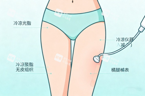 腿部做吸脂卡通图一览