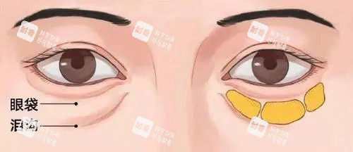 眼周眶隔脂肪位置示意图 眼周眶隔脂肪位置示意图