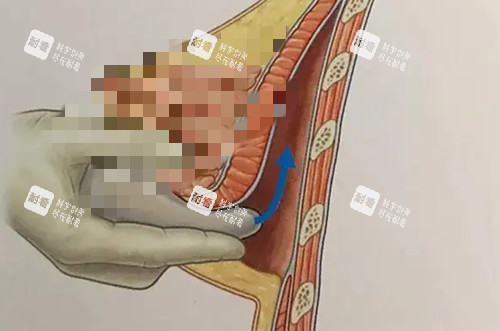 假体隆胸手术卡通示意图