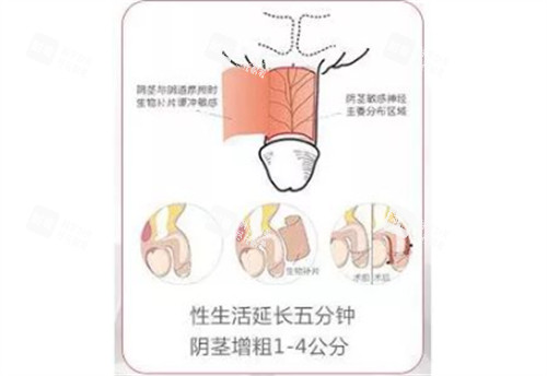 阴茎生物补片手术结果