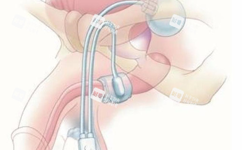 男性私密整形勃起治疗卡通示意图