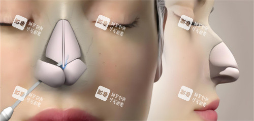 鼻综合鼻骨动画 鼻综合鼻骨动画