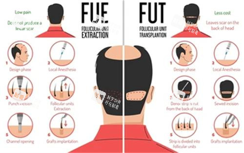 不同植发技术对比图解