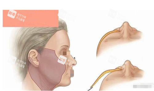 拉皮手术术中示意图