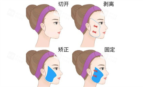 看刘杰伟拉皮实例选医生！不同年龄、松弛情况改善结果一目了然