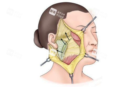发际耳后切口拉皮手术示意图