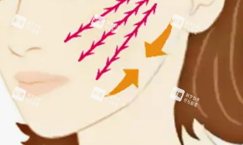 拉皮手术的大致流程示意图