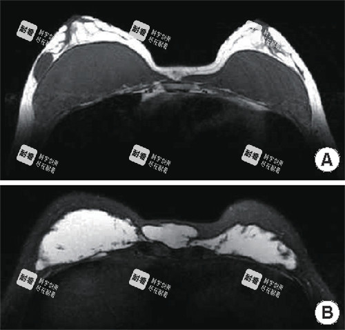 不明注射物在胸部的样子