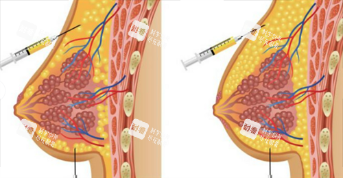 胸部奥美定注射物