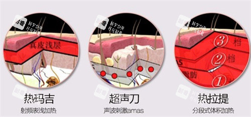 热玛吉、超声、热拉提 热玛吉、超声、热拉提