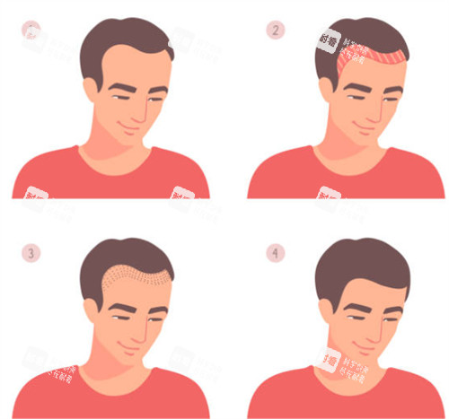 发际线植发前后图解 发际线植发前后图解