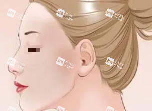 光子嫩肤示意图