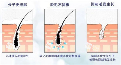 脱毛后毛囊的变化