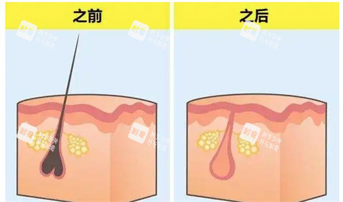 脱毛前后的毛囊