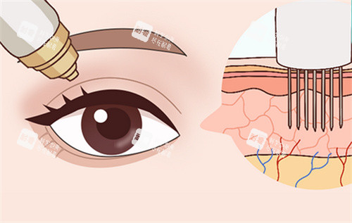 眼部黄金微针卡通图 眼部黄金微针卡通图