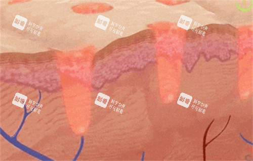 黑曜双波黄金微针治疗过程 黑曜双波黄金微针治疗过程