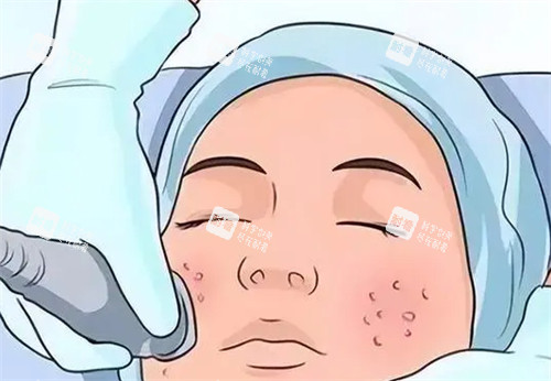 黄金微针施术中 黄金微针施术中