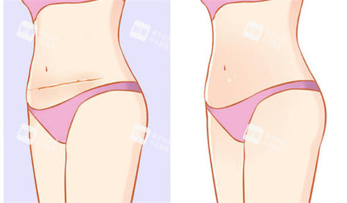 剖腹产疤痕修复前后对比