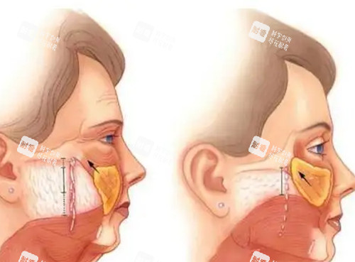 面部筋膜层拉皮提升卡通示意图