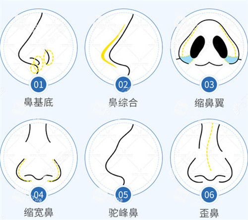 不同隆鼻技术图解