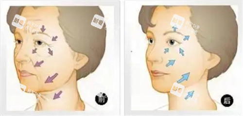 面部抗衰对比图 面部抗衰对比图