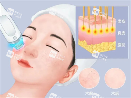 黑曜双波黄金微针治疗层次