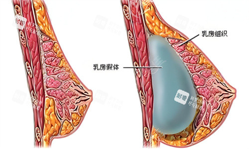 假体隆胸术原理图 假体隆胸术原理图