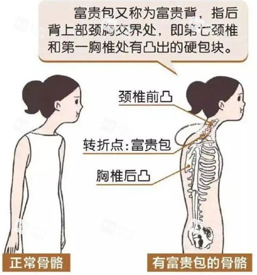 正常骨骼跟有富贵包的骨骼