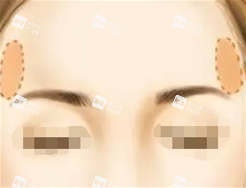 面部脂肪填充丰太阳穴动画展示图 面部脂肪填充丰太阳穴动画展示图