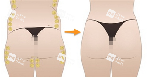 臀部脂肪填充过程展示图 臀部脂肪填充过程展示图