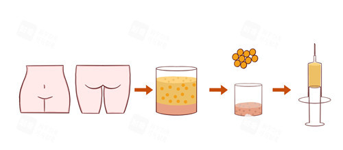 脸部脂肪填充图 脸部脂肪填充图