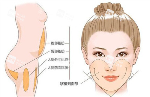面部脂肪填充卡通图 面部脂肪填充卡通图
