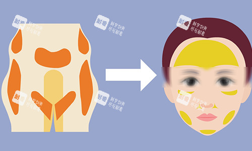 脂肪填充动画图 脂肪填充动画图