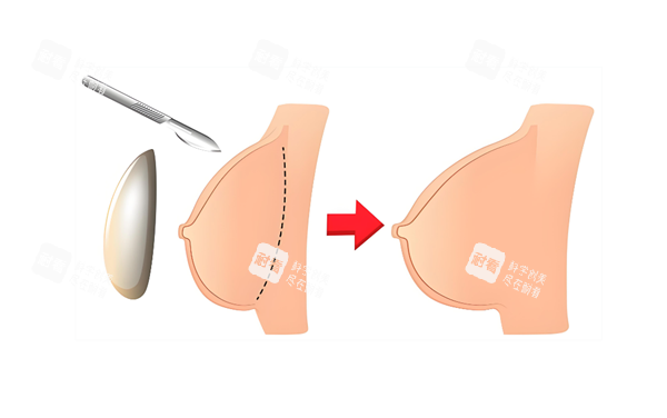 假体隆胸过程图 假体隆胸过程图