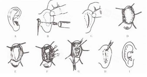耳朵矫正手术