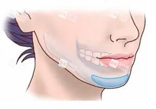 假体垫下巴卡通示意图