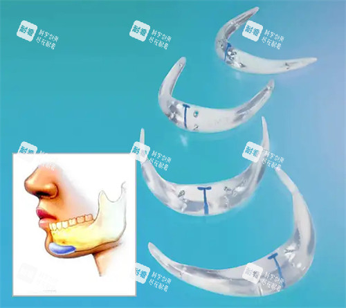 下巴后缩填充手术展示图