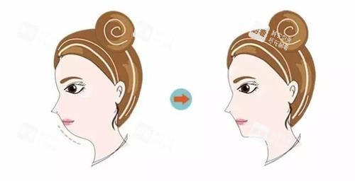 垫下巴前后的变化