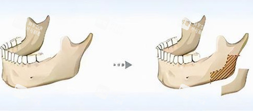 下颌骨劈外板卡通示意图