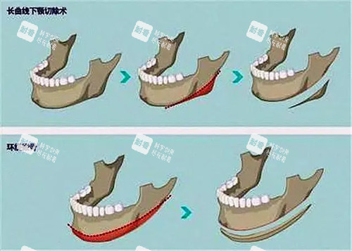 不同下颌骨结构方式对比图