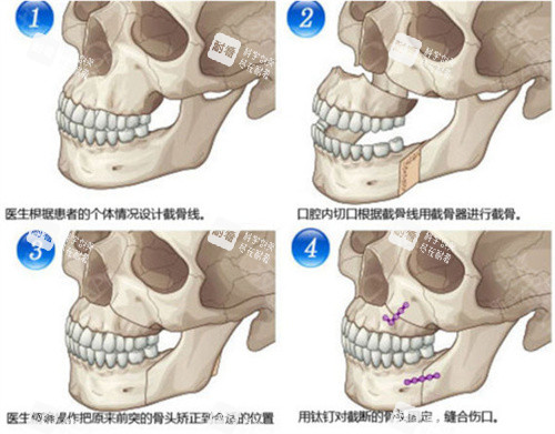 下颌骨矢状劈开术手术步骤演示图