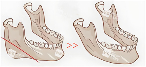 下颌骨切除步骤动画演示图