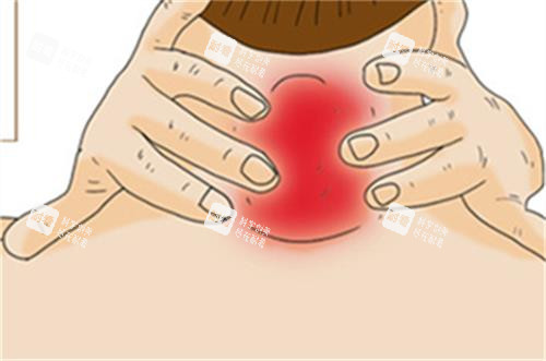 黄学峰医生做富贵包靠谱么？采用定位旋切法，伤口仅3mm且修复快口碑不错