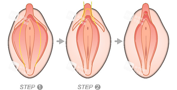 大阴唇手术怎么做