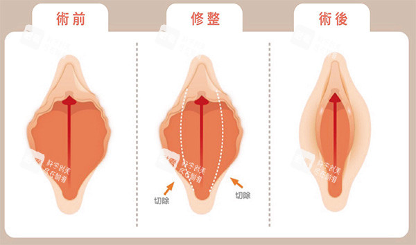 外阴唇切除术前术后