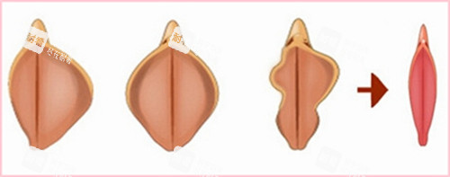 阴唇肥大和理想阴唇对比动画图