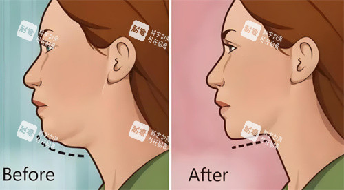 热拉提前后对比 热拉提前后对比