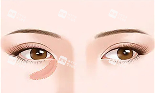 余益民医生简介：眼周口周年轻化19800起，专攻抗衰改善细纹~