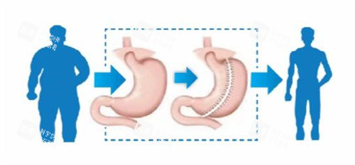 袖状胃切除手术优势卡通图 袖状胃切除手术优势卡通图
